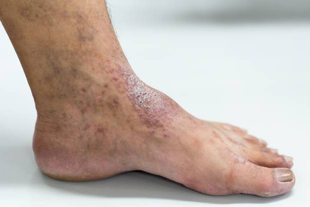 8 načina na koje vam stopala otkrivaju problem sa zdravljem