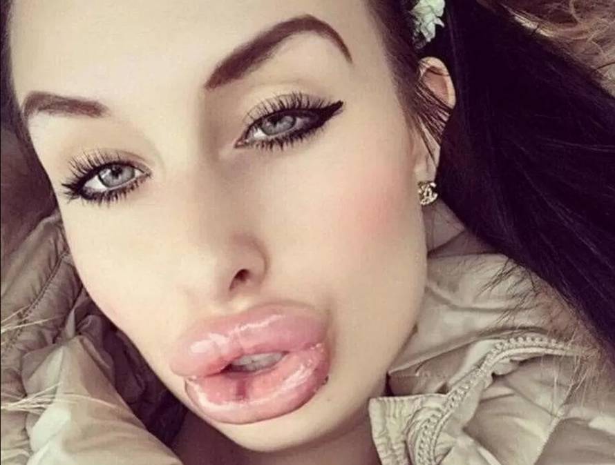 Pretjerale su s filerima: Zovu ih 'jeftinim porno glumicama'