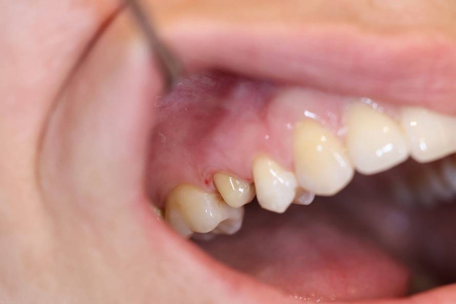 Osmijeh koji izgleda prirodno? Tajna je u preciznom planiranju i kvalitetnom materijalu