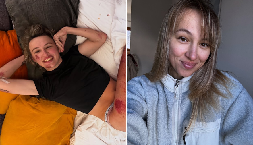 VIDEO Biciklistkinja pozirala u donjem rublju i otkrila ozljede: 'Imam prilično čvrste kosti'