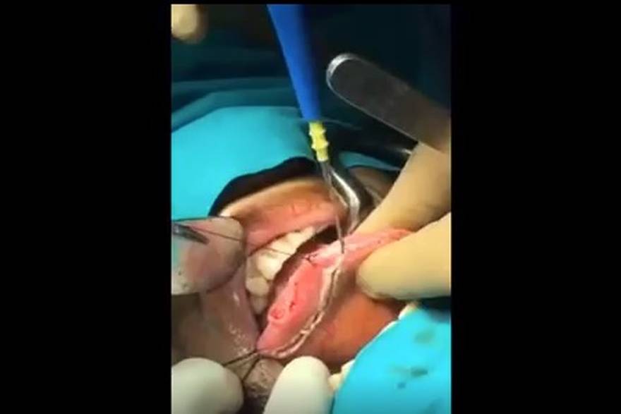 Operacije raka na jeziku