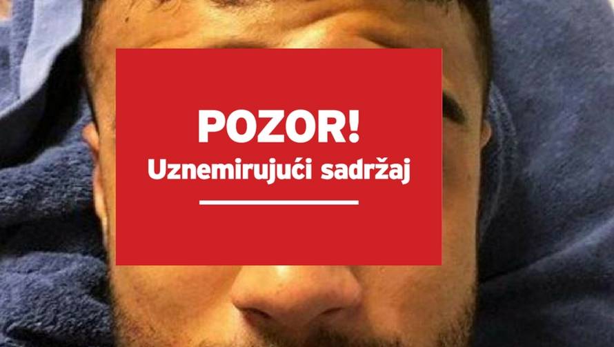 Nije za one slabog srca: Grozna ozljeda glave Barcinog Rafinhe