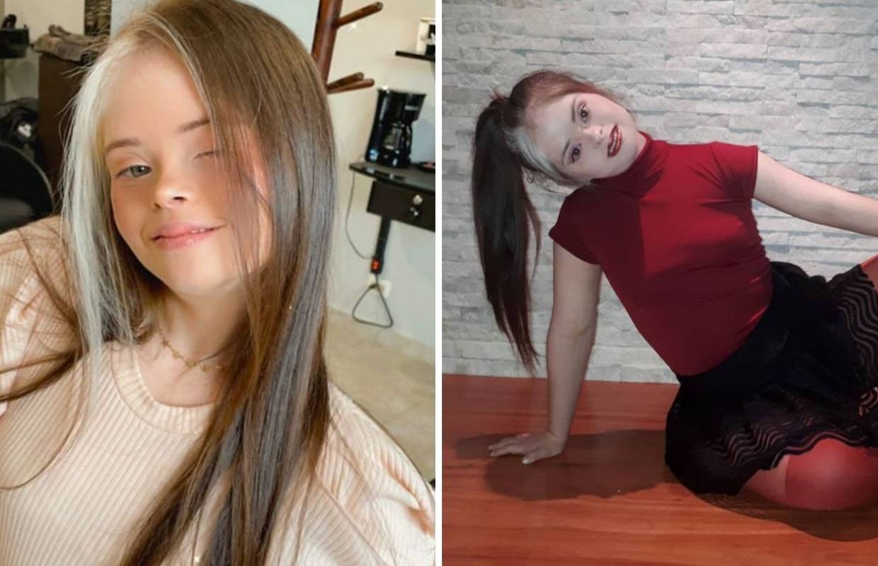 Ima Downov sindrom, ali to je nije spriječilo da postane model