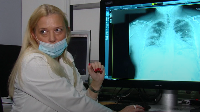 Liječnica u KB Dubrava pokazala što korona radi plućima pacijenta koji nije cijepljen