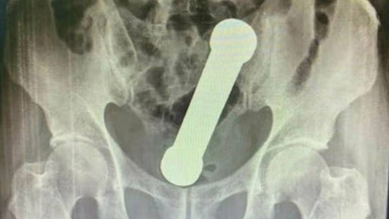 PA KAKO? Doktori mu iz anusa izvadili uteg od dva kilograma