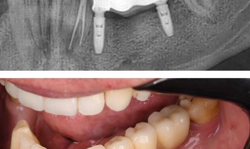 Kako izgleda oporavak nakon ugradnje implantata iz tjedna u tjedan