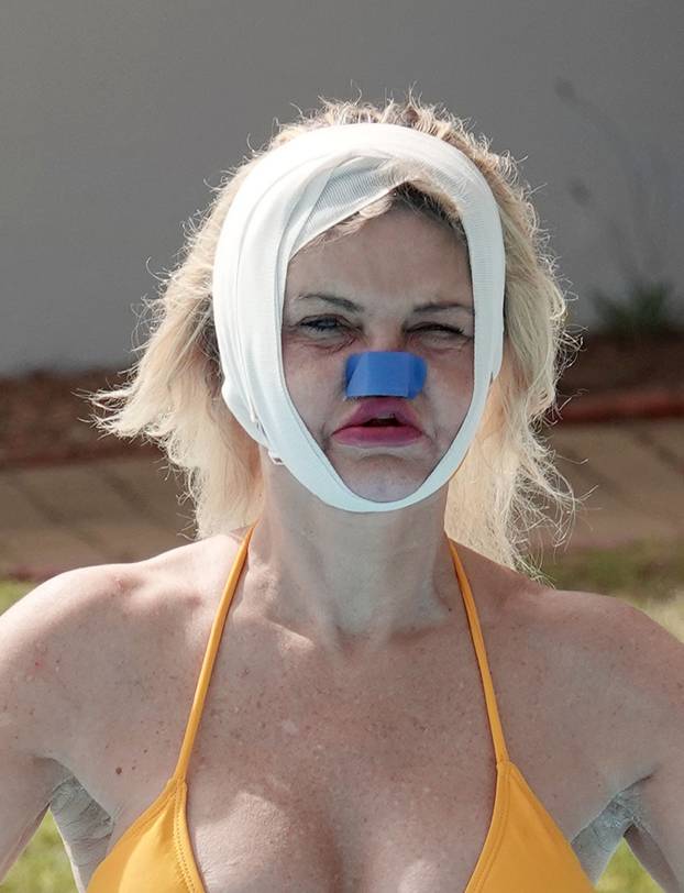 *PREMIUM-EXCLUSIVE* *MUST CALL FOR PRICING* Former Eastenders Actress Danniella Westbrook underwent life-changing surgery to rebuild her face as the star was sunbathing with bandages around her head and nose out in Turkey.