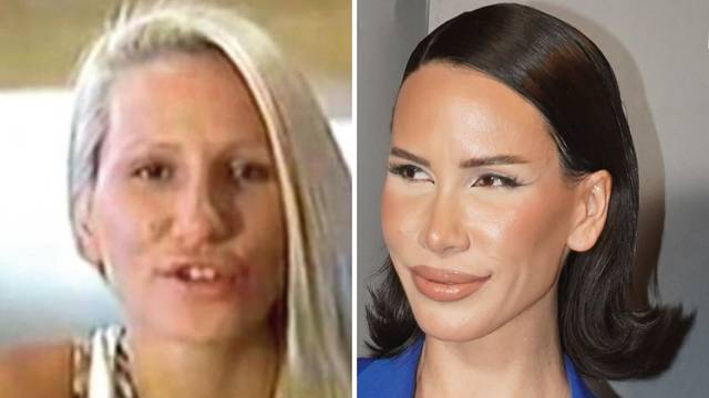 Srpska pjevačica promijenila je cijelo lice, ali neke operacije požalila: Ovako je izgledala...