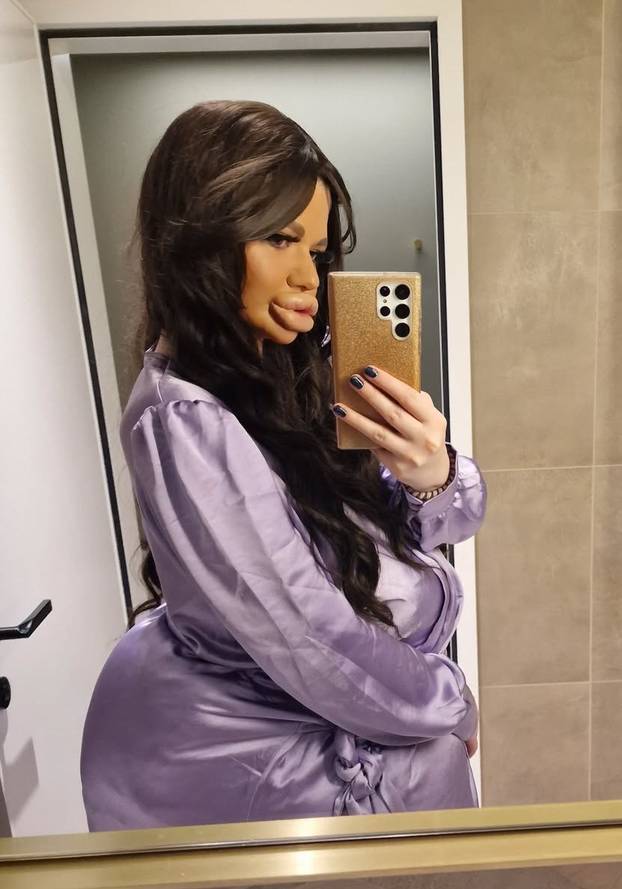 FOTO Andrea ima najveće usne na svijetu: Teško se smijem, ali ne mislim stati s operacijama...