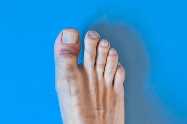Damaged big toe on a blue background