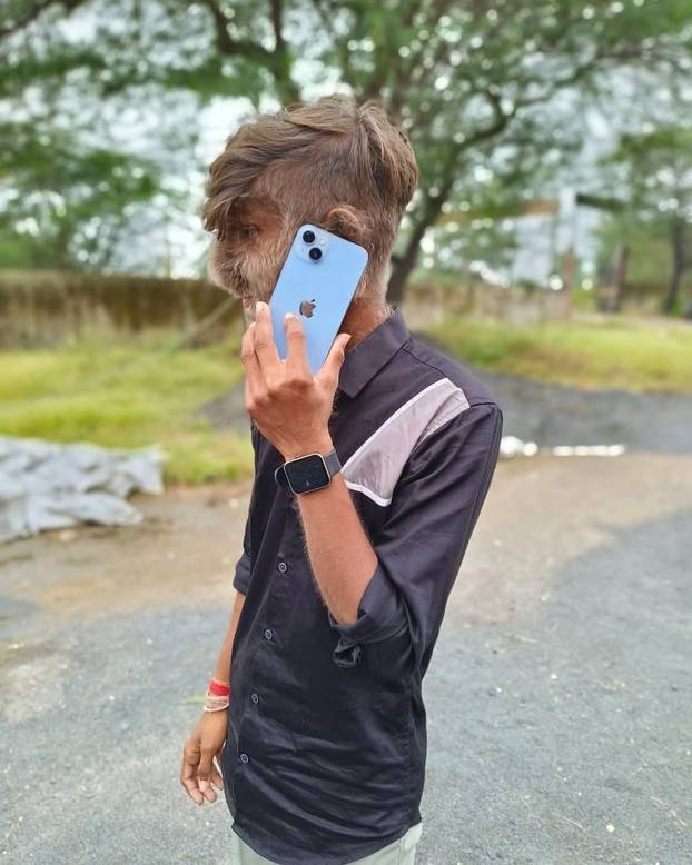 FOTO Ovaj mladić (18) pati od sindroma vukodlaka: U školi me sprdaju, ali volim svoje dlake...