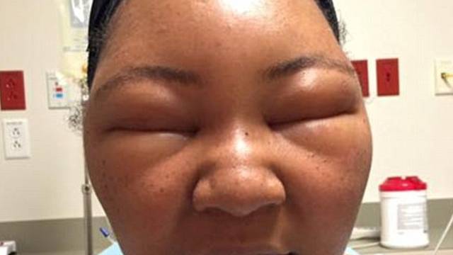 Zastrašujuća alergija: Obojala je kosu s kanom i nije vidjela