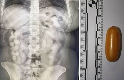 Ovo je rendgen Brazilke koja je u Zagrebu pala s kilu kokaina: Progutala 76 kapsula s drogom