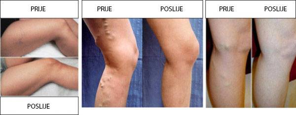 Svaka 2. hrvatica pati od proširenih vena! Poduzmite nešto