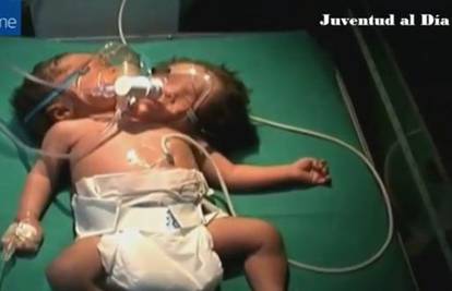 Rodila je bebu s dvije glave: Nije imala novca za ultrazvuk