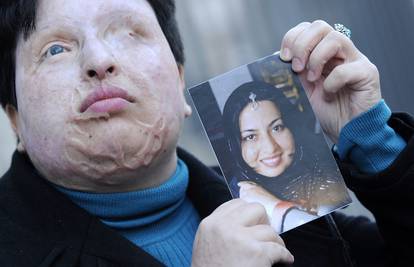 Odgodili osvetu: Irancu (27) za sada neće usuti kiselinu u oči