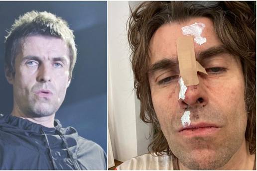 Liam Gallagher u masnicama nakon pada iz helikoptera: 'Sad imam fotku za cover albuma'