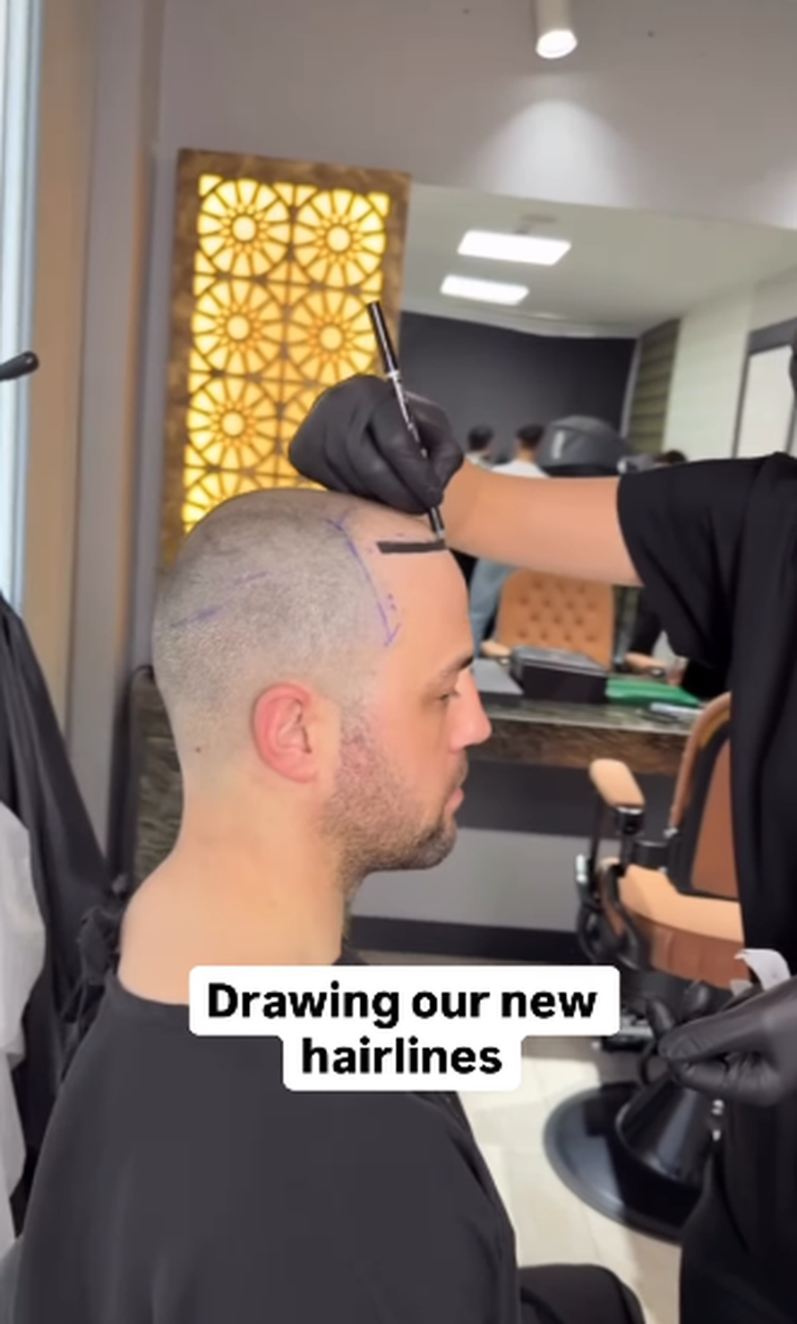 Trojčeki otputovali u Tursku na transplantaciju kose: 'Ne može samo jedan imati dobru frizuru'