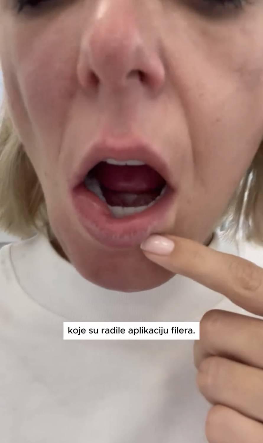 Fileri joj uništili lice: Stankica iz 'Gospodina Savršenog' ponovno je bila na estetskom zahvatu...