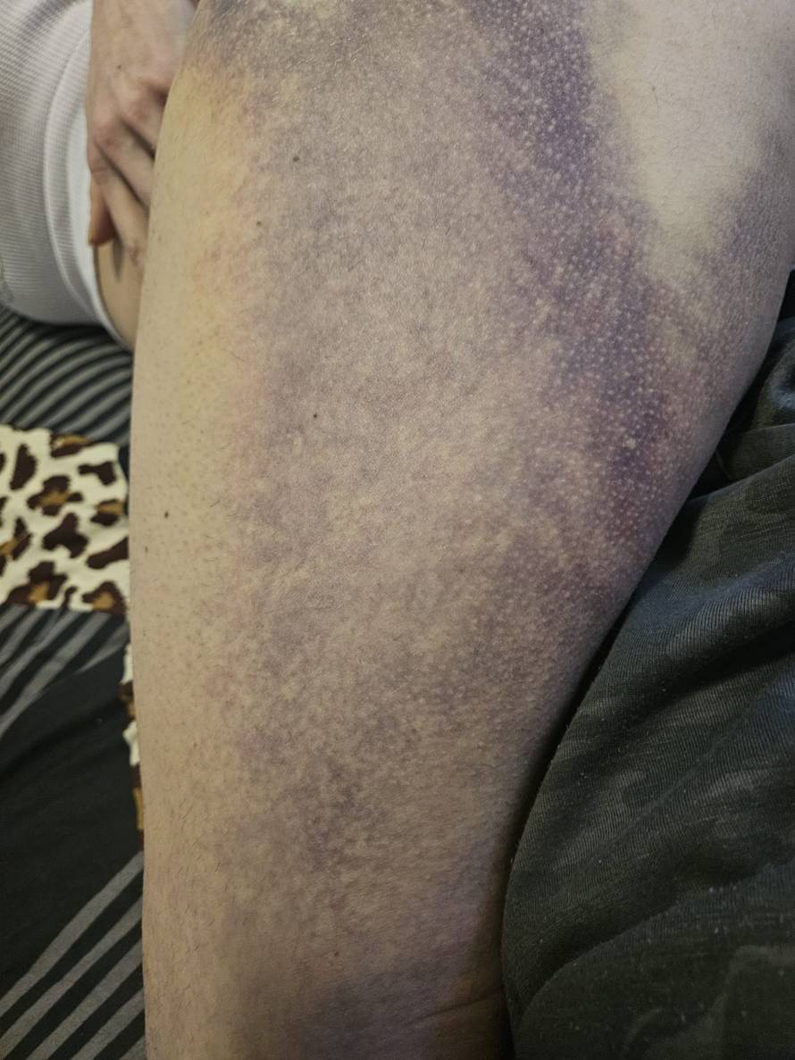 Super Silva za 24sata: Znam tko me napao, bilo je iznenada i s leđa. Jedna noga mi je uništena