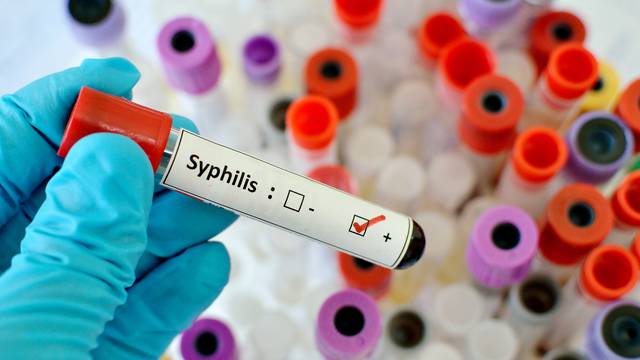 Sve više sifilisa, ali hrvatski liječnici poručuju: Bez panike...