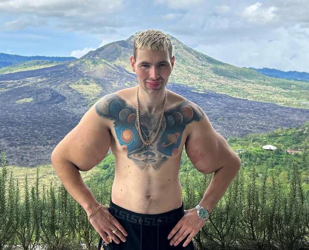 FOTO 'Ruski Popaj' mogao bi izgubiti obje ruke zbog teške infekcije: Ubrizgava kemikalije!