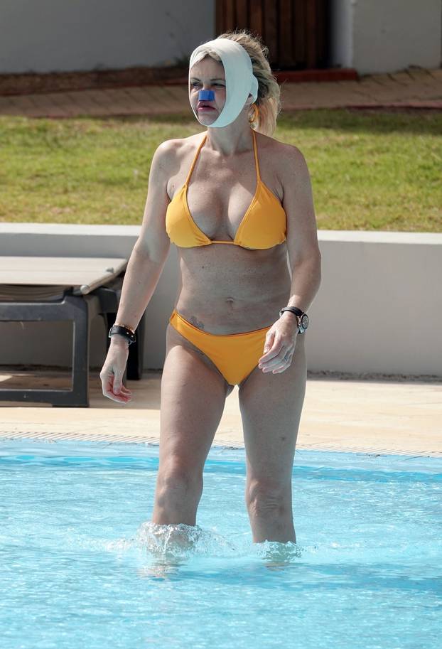 *PREMIUM-EXCLUSIVE* *MUST CALL FOR PRICING* Former Eastenders Actress Danniella Westbrook underwent life-changing surgery to rebuild her face as the star was sunbathing with bandages around her head and nose out in Turkey.