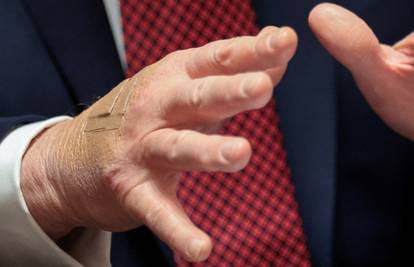 Trump opet ima flastere na rukama. Ovo je objašnjenje