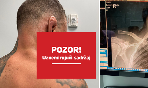 Jezivo! UFC borac pokazao kako mu se odvojila klju&ccaron;na kost uo&ccaron;i me&ccaron;a. Uspio je pobijediti...
