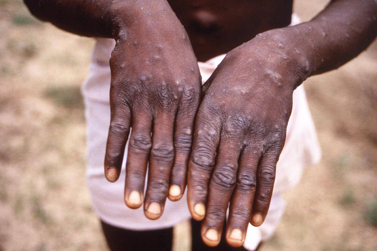 A CDC image shows a rash on a monkeypox patient