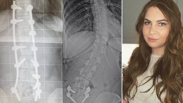 Djevojka (23) živi s 13 vijaka u kralježnici i ne može se sagnuti