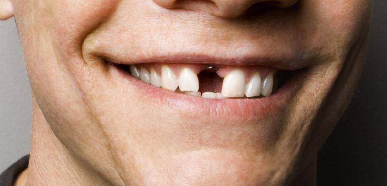 Zaboravi implantate! Uskoro će vam zubi izrasti za 9 tjedana