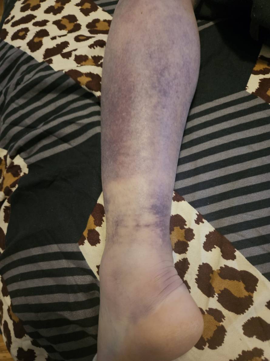 Super Silva za 24sata: Znam tko me napao, bilo je iznenada i s leđa. Jedna noga mi je uništena