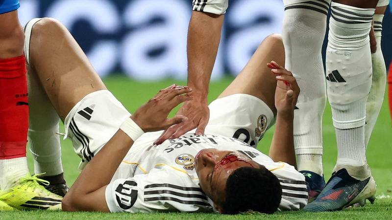 Kylian Mbappé objavio fotku gadne posjekotine uoči Bayerna