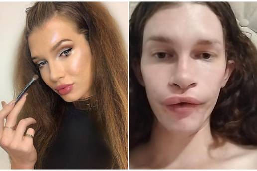 FOTO Htjela je biti žena mačka, a sad plače: Dala sam 7000 €, a fileri su me unakazili! Pomiču se