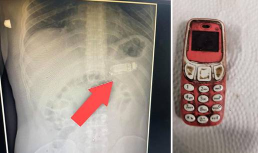 Četiri dana hodao s 'Nokijom 3310' u želucu, izvadili je bez reza: Navodno Snake još radi