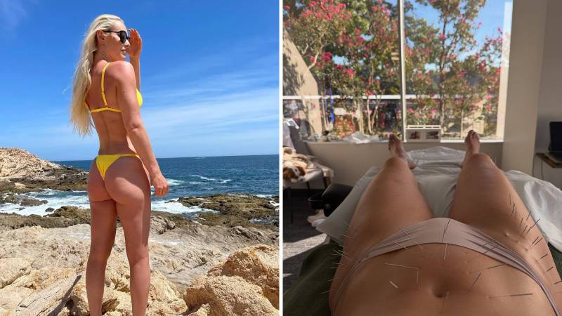 FOTO Lindsey samo u gaćicama i prepuna iglica: Skijaška kraljica ide na novu tešku operaciju...