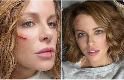 Vizažistica Tatjana o povredama Kate Beckinsale: 'Ozljede nisu stvarne, ja sam ju našminkala'