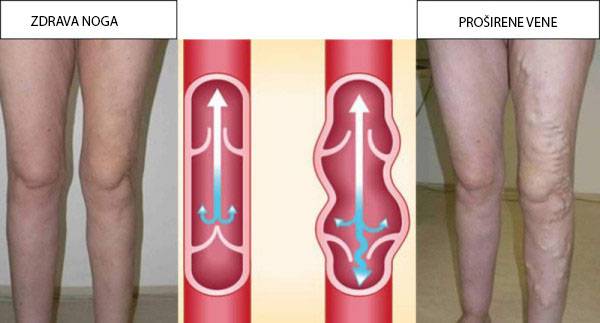 Svaka 2. hrvatica pati od proširenih vena! Poduzmite nešto