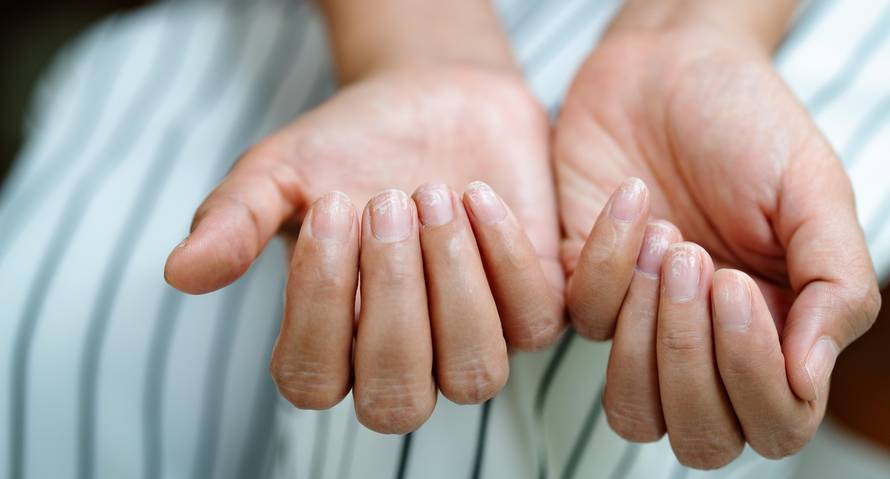 5 rješenja za lomljive nokte: Idealna ulja, hrana, pilinzi i gel
