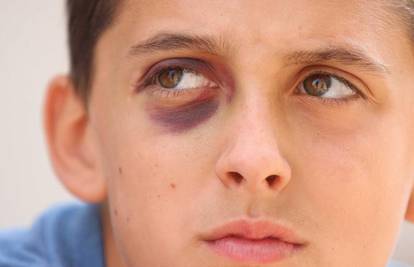 Umalo izgubio oko: Dječak u školi pao i ozlijedio oko
