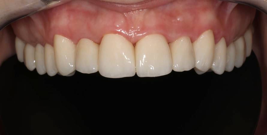 Osmijeh koji izgleda prirodno? Tajna je u preciznom planiranju i kvalitetnom materijalu