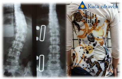 Kuća zdravlja - 15 godina suvremenog liječenja skolioza
