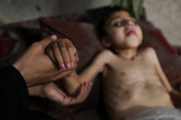 Displaced Palestinian mother Samah Matar holds the arm of her malnourished son Ameer, in Gaza City