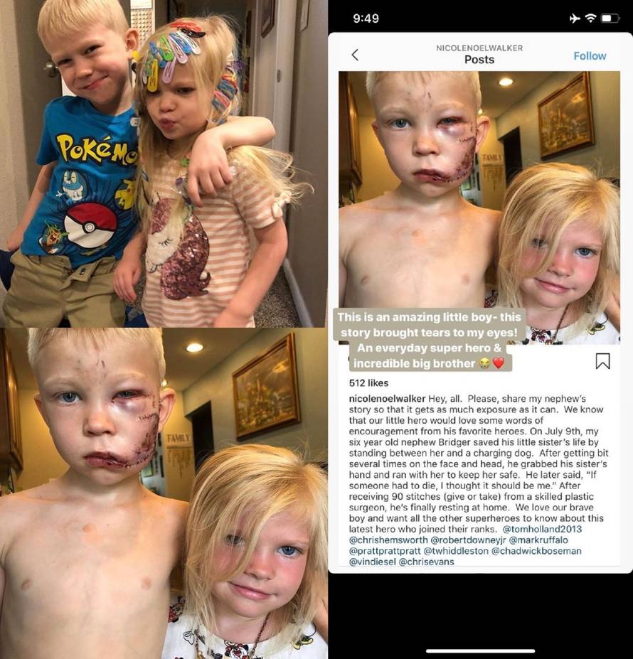 Dječak (6) spasio mlađu sestru od ugriza psa: Dobio 90 šavova