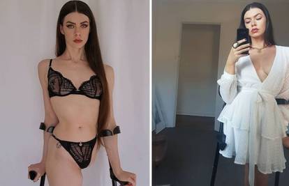 Model bez noge u šoku: Govore mi da od sebe radim invalida u Photoshopu zbog 'lajkova'