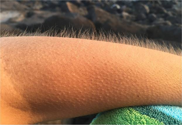 Trnci na ko&zcaron;i