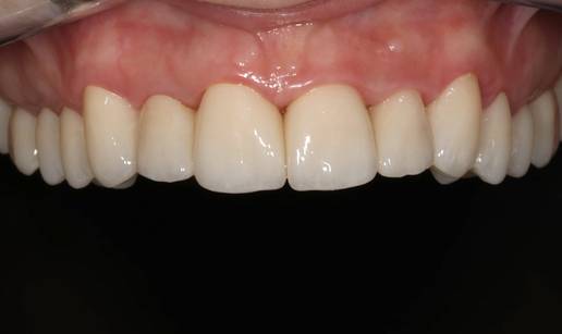 Osmijeh koji izgleda prirodno? Tajna je u preciznom planiranju i kvalitetnom materijalu