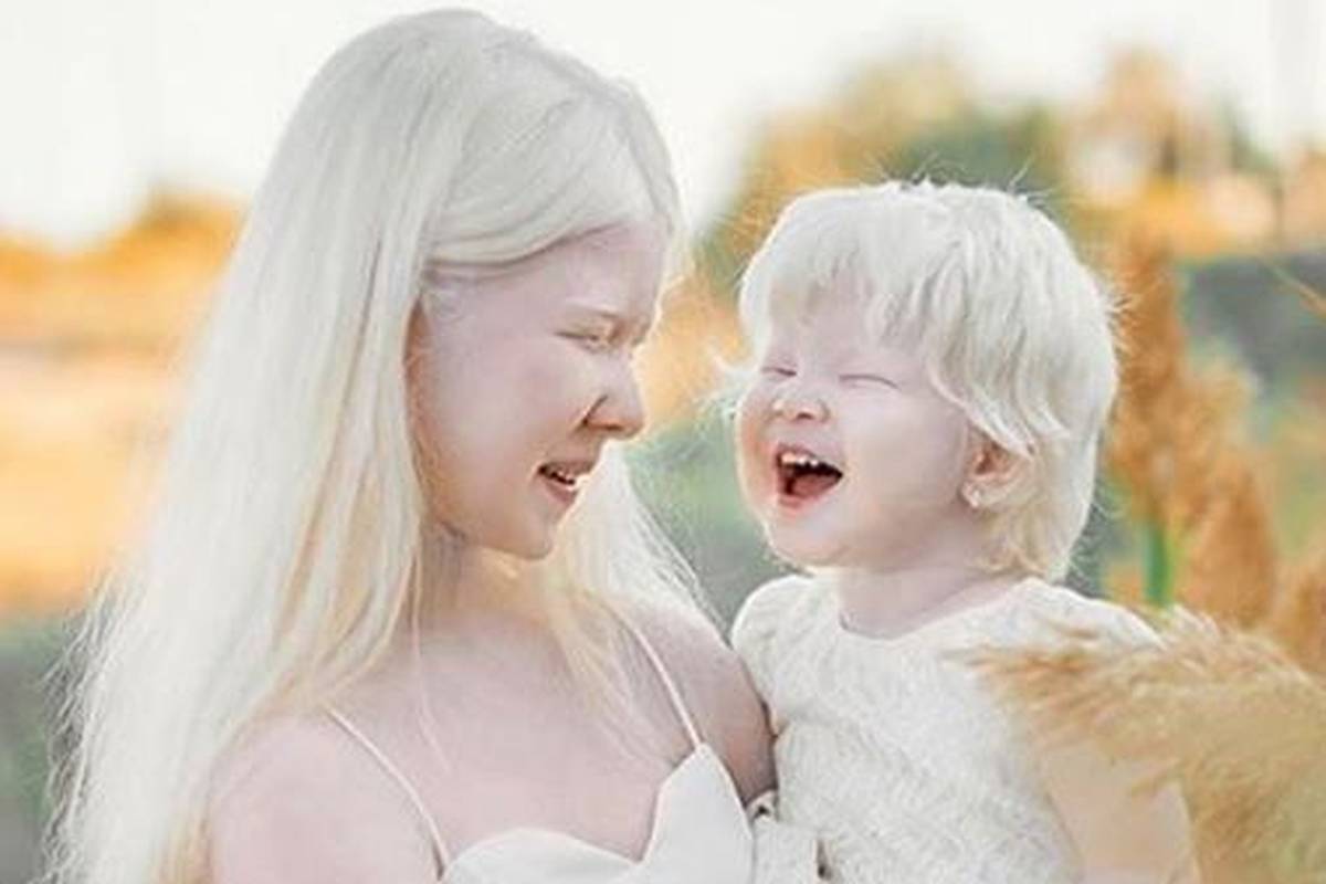 Predivne albino sestre osvajaju svijet, izgledaju kao dva anđela