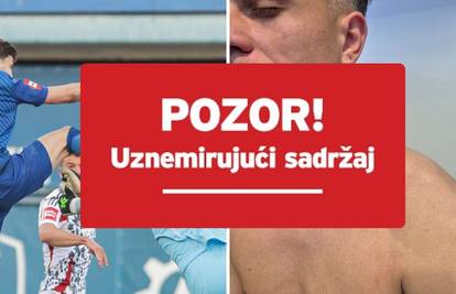 FOTO Ovako izgleda lice Lučića nakon opasnog starta Galešića